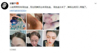 张馨予晒出腿部淤青照：现在跳舞我也有调色盘