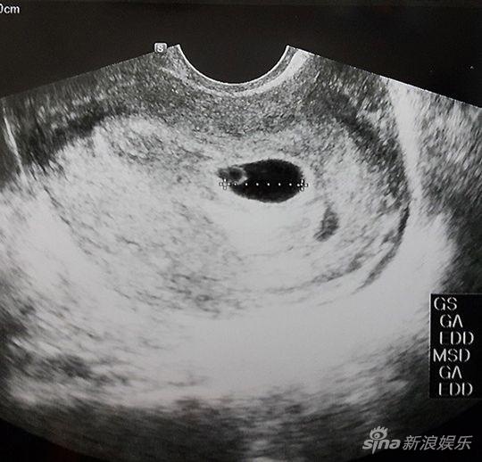 孕检图片真实 一个月图片