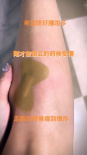 張柏芝倒立失手跌傷腳 小腿紅腫直呼“痛到爆炸”